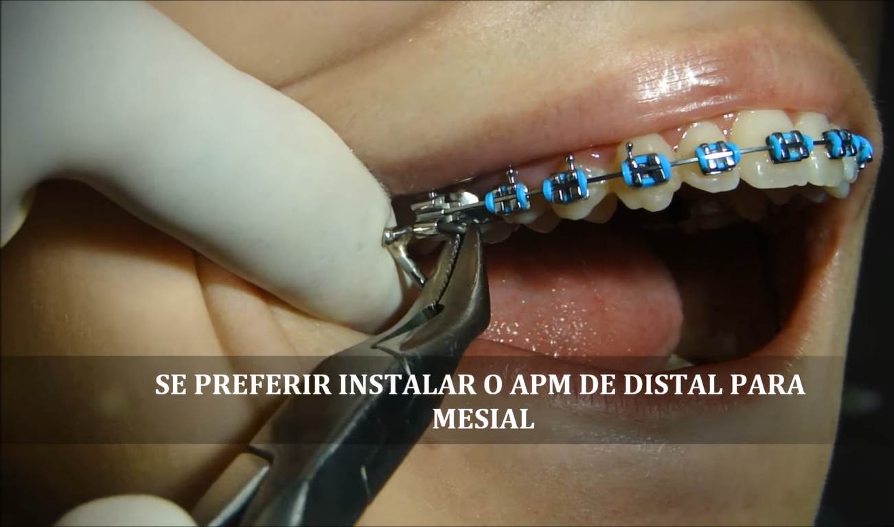 Como instalar um APM Aparelho Propulsor Mandibular Hélio Venâncio