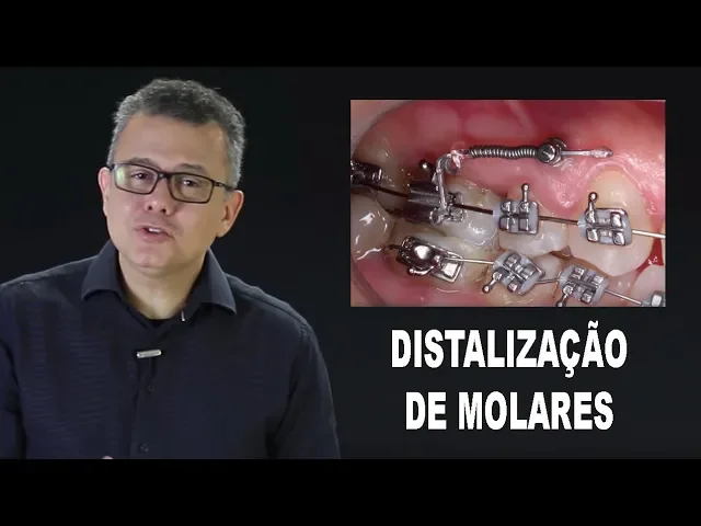 Distalização de Molares com Mini Implantes