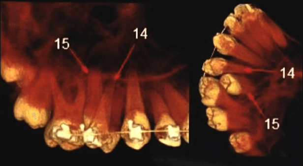dente pré molar retido