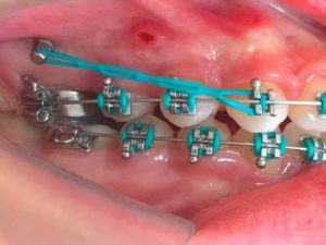 Distalização de molares com mini-implante e elástico corrente.